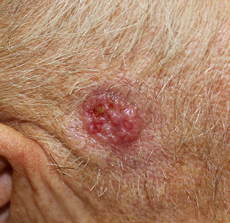Photo of a basal cell skin cancer
