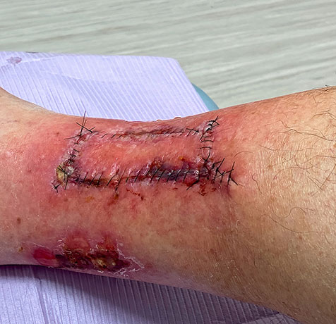 A wound with stiches