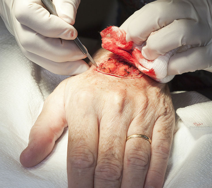 Photo of a skin surgery on a hand