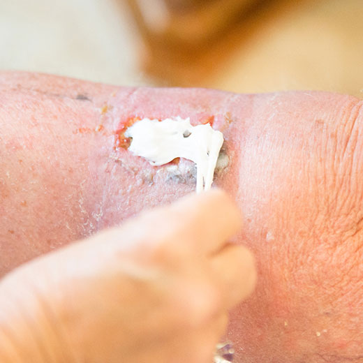 A doctor spreading a cream on a wound