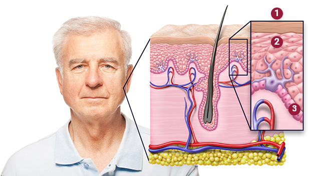 Illustration showing the epidermis, squamous cells and basal cells.