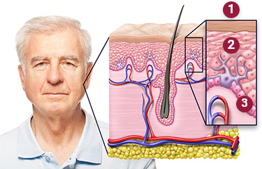 Illustration showing the epidermis, squamous cells and basal cells.