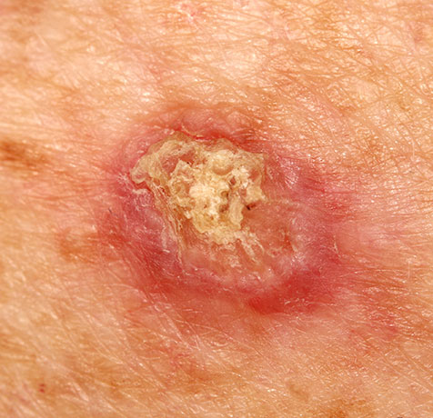 Photo of a skin cancer spot