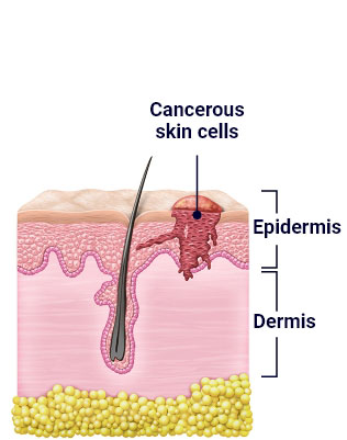 Illustration that shows the first step in a skin cancer surgery