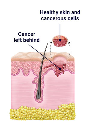 Illustration that shows the second step in a skin cancer surgery