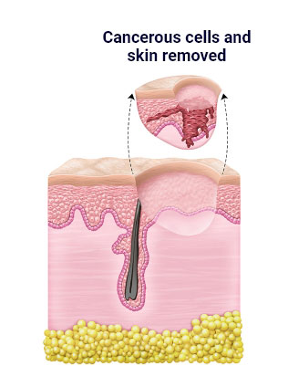 Illustration that shows the third step in a skin cancer surgery